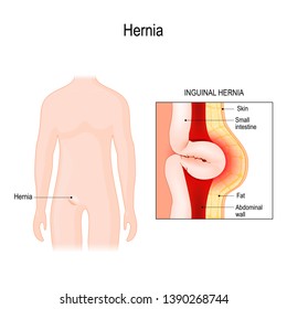 Inguinal Hernia. bowel exit through the wall of the abdomen cavity. Vector diagram for educational, medical, biological, and scientific use