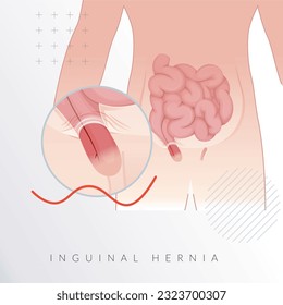 Inguinal Hernia-  Section of the Intestines - Stock Illustration as EPS 10 File