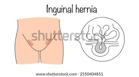 Inguinal hernia. Subcutaneous protrusion of internal organs, resulting from an expanded slit-like space in the abdominal wall. A simple vector for use in the medical field.