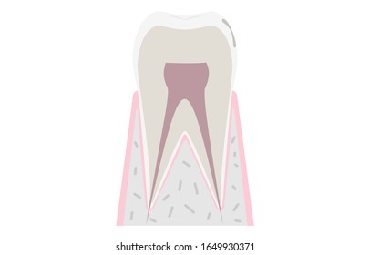 Initial stage of caries, cloudy surface