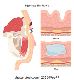 Injectable cosmetic filler. Face features correction or anti-aging beauty procedure technique. Before and after treatment comparisson. Flat vector illustration