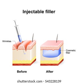 injectable cosmetic filler. How it works. Procedure. Before and after injection.