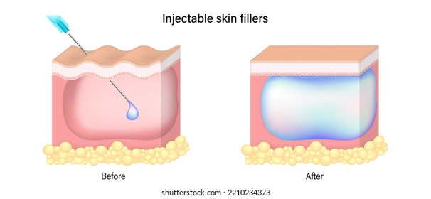 Injectable skin fillers. Dermal fillers. Skin before and after injecting of filler.