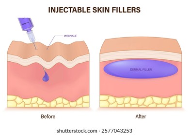 Injectable skin fillers. Dermal fillers. Skin before and after injecting of filler. Vector for advertising about beauty and medical treatment.