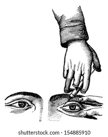 Injecting the Nasolacrymal Canal, vintage engraved illustration. Usual Medicine Dictionary by Dr Labarthe - 1885