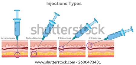 Injection angle types. Intramuscular, subcutaneous intradermal, intravenous injection. Guide injecting medication into skin, holding syringes. Vector illustration