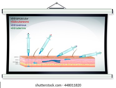 Injection diagram with syringe illustration