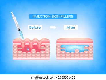 Injektion von Einfüllstutzen unter die Haut auf dem Gesicht mit Hautfalten vor und nach der Injektion. Fettsäure (HA-Filler). Medical and Beauty Concept. Vektorgrafik EPS10.