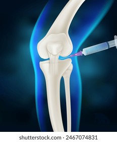 Injection into the knee joint Drug treatment method for alleviating knee injuries in humans. Realistic vector illustration.