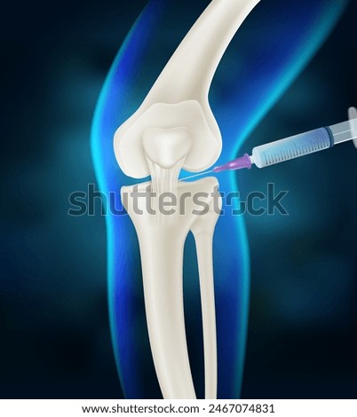 Injection into the knee joint Drug treatment method for alleviating knee injuries in humans. Realistic vector illustration.