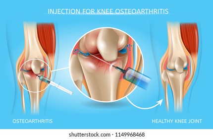 Injection for Knee Osteoarthritis Realistic Vector Medical Scheme. Medications Administration with Syringe Needle to Damaged Joint and Healthy Because of Treatment Knee Anatomical Illustration