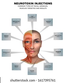 Injections for facial wrinkles. Common types of facial wrinkles. Neurotoxin injections treatment areas, muscles targeted and results. 