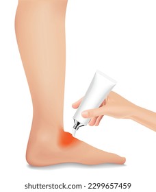 The injured foot is red and swollen like a realistic, treatment with medication. vector illustration.