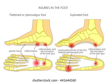 Injuries Foot Plantar Fasciitis Heel Spur Stock Vector (Royalty Free ...