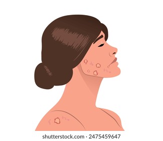 Injuries and wounds on the face, dermatological problems, scars from pimples and blackheads. vector illustration.