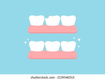 Injury chipped tooth and healthy tooth before, after treatment icon set. Broken teeth with problem treatment concept. Flat cartoon style vector illustration.