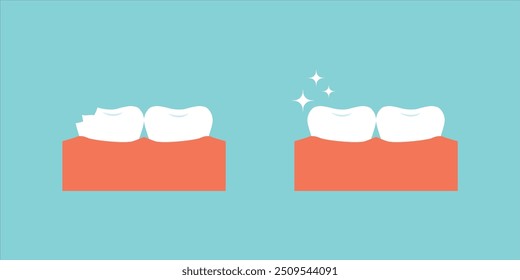 Lesión diente astillado y diente sano antes, después del conjunto de iconos de tratamiento. Dientes rotos con concepto de tratamiento de problemas.