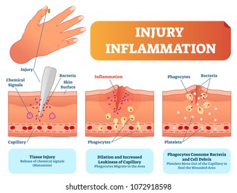 Injury inflammation biological human body response vector illustration scheme. Skin surface injury cross section poster with capillary, phagocytes and platelets fighting bacteria and healing wound.