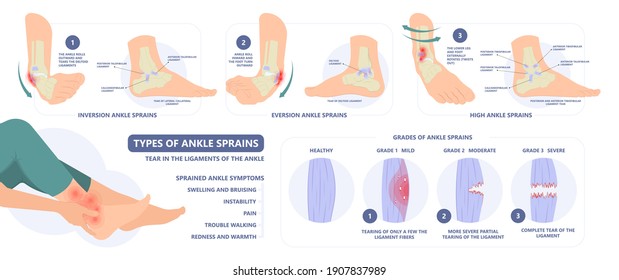 Anatomie von Knöchelbesprühungen mit Sehnenriss und Verletzungen
