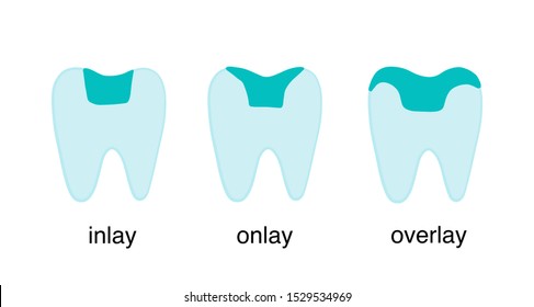 Inlay Onlay Overlay Tooth Crown Restoration Porcelain Hand Drawn Vector Illustration Type Classification Dentistry Poster