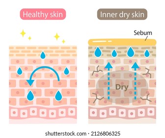 innere trockene Hautschicht. Die Haut erzeugt zusätzliches Sebum, um Feuchtigkeit zu erzeugen, aber unten wird durch Wasserverlust dehydriert. Schönheitskonzept für Hautpflege