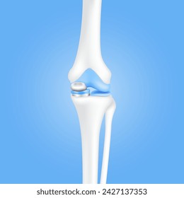 Tratamiento de tecnología médica de innovación. La cirugía de reemplazo de rodilla parcial o implante para el tratamiento alivian la artritis, después de que la articulación se dañó. Hueso de la pierna y cartílago. Vector realista 3D EPS10.