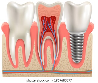 Inplant teeth eps 10 vector
