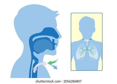 671 Tracheostomy Images, Stock Photos & Vectors | Shutterstock