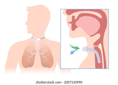 Insert the siliconized tube into the trachea to help breathe into the lunge. Illustration about Anatomy of Tracheostomy is surgical at the neck and windpipe to help a patient.