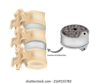 Insertion of artificial disc. Disc Replacement Artificial Disc. Arthroplasty