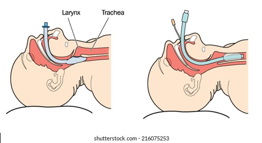 Insertion of an endotracheal airway tube for assisted ventilation,showing the relationship between the trachea and oesophagus with tube in situ.