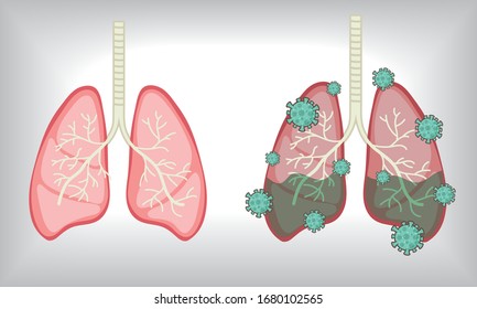 27,153 Bad lungs Images, Stock Photos & Vectors | Shutterstock