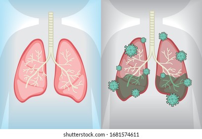 Im Körper eines Mannes. Besonders Lungen. Vergleichen Sie gesunde Lungen mit Infektionen. Kick und feiner Mann. Von Corona Covid19 Virus angegriffen.
