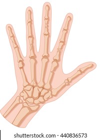 Inside of hand fracture illustration