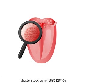 Inspection taste receptors on tongue illustration. Examination of mucous tissues under magnifying glass for presence candida flexes and vector lesions.