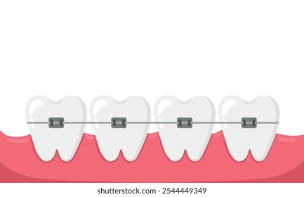 Instalación de aparatos ortopédicos en los dientes, enderezamiento de mordeduras torcidas. Ilustración vectorial