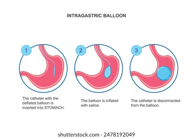 Installation of a gastric balloon into stomach. Methods of weight loss surgery. Bariatry. Human body organ anatomy and health care illustration infographics.