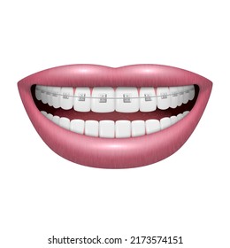 Installed braces on white smiling teeth open human mouth realistic 3d icon vector illustration. Orthodontic medical clinic treatment individual dentistry aesthetic and health service. Happy oral smile