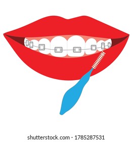 Installed braces on a woman's teeth and a brush for cleaning them. Stock vector illustration isolated on white background. Medical dental braces for an orthodontist and a special brush for cleaning