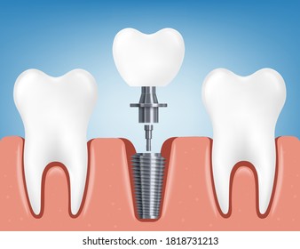 Installing a dental implant among healthy human teeth. Parts of dental implant - crown, abutment and screw. Dental surgery. Realistic 3D vector illustration.