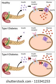 Insulin action and diabetes type 1 and type 2