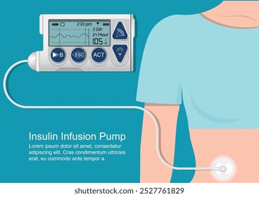 Insulin infusion pump is a device that simulates the function of the pancreas and acts to release insulin into the body, insulin infusion therapy (CSII) is used in patients, medical healthcare vector.