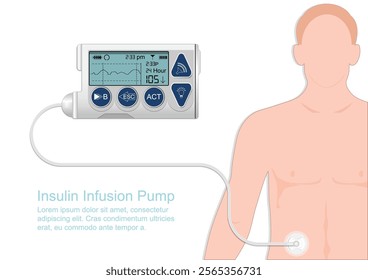 Insulin infusion pump is device that simulates the function of the pancreas and acts to release insulin into the body, insulin infusion therapy (CSII) is used in patients, medical healthcare vector.