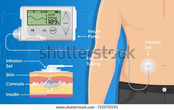 Insulin Infusion Pump on Patient Body Electronic\
Medical Digital Technology Device Therapy Diabetes Sugar Blood\
Automatic Control by Programming and Monitoring Glucose with Bio\
Sensor Clinical