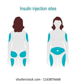 Insulin injection sites. Diabetes mellitus. Female body front and back view with
Areas for Injection. Vector illustration for biology, scientific, and medical use.