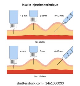 Insulin Injection Technique In Diabetes For Adults And Children, Depending On The Length Of The Needle. Anatomical Vector Illustration In Flat Style Isolated On White Background.