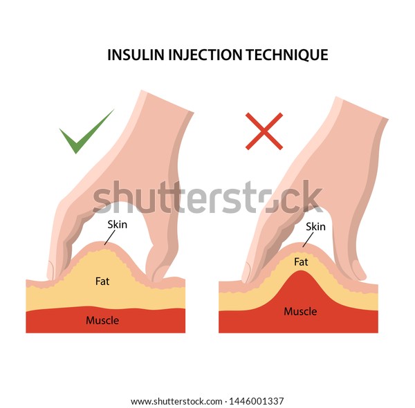 糖尿病のインスリン注射法 正しい注射と誤った注射が示されています 白い背景に平らなスタイルの解剖学的ベクターイラスト のベクター画像素材 ロイヤリティ フリー