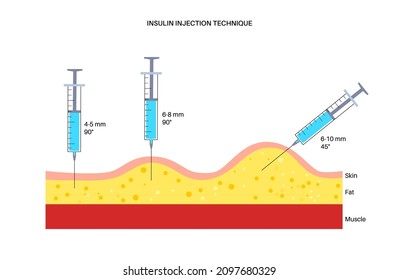 Insulin Injection Technique. Diabetes Disease. Different Injections For Adults And Children. Syringe Enters The Fat Layer Through Skin And Does Not Touch Muscles. Anatomical Flat Vector Illustration