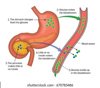 Insulin und die Bauchspeicheldrüse in der Rolle des Glucosestoffwechsels, die die Wirkungen des Diabetes zeigen.