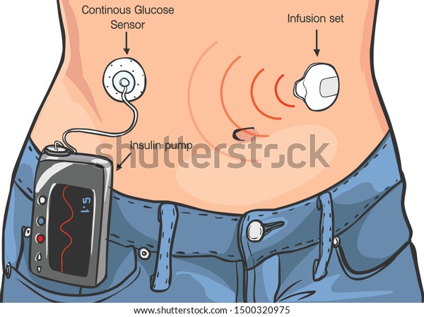 Insulin\
Pumps for Diabetes Patients Vector\
İllustration